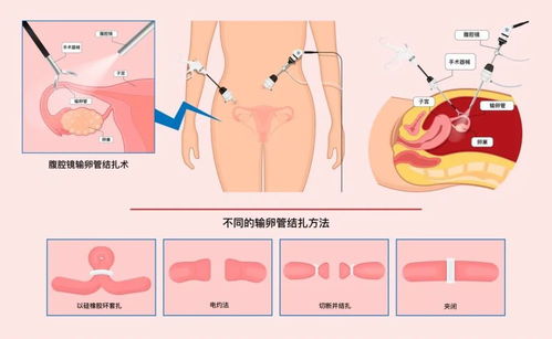 结扎可以挽回吗女人,女人绝育后还能挽回吗？