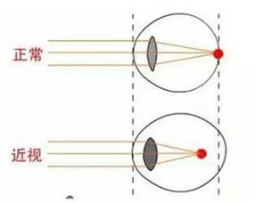 怎样才能挽回视力,如何有效恢复视力