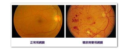 视力0.1该怎么挽回,如何挽回0.1视力