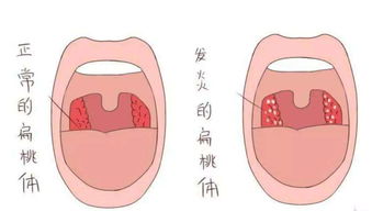 声音较粗如何挽回,如何挽回喉咙疲劳？