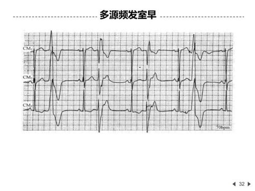 房颤能不能挽回,治疗房颤有望恢复正常心率