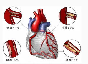 溶栓后怎么挽回,溶栓后如何恢复血管通畅？